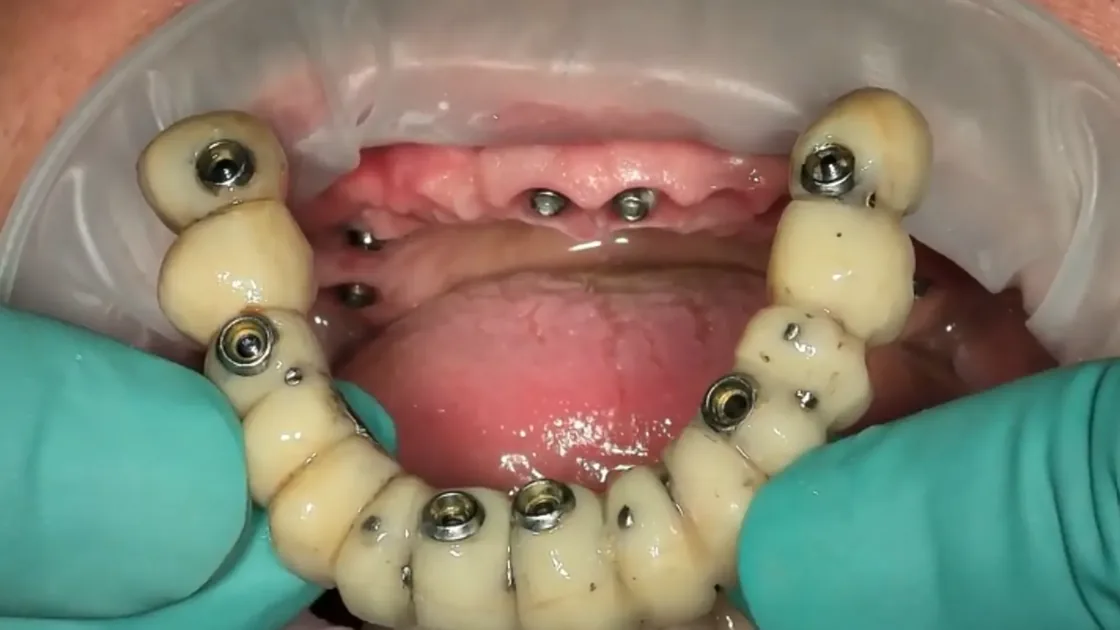 Lesson 1: An introduction to FP-1 prosthesis