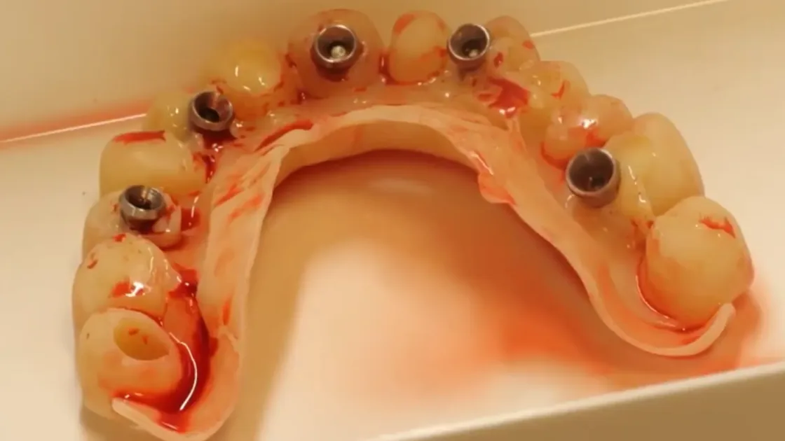 Lesson 3: Surgical guides and provisional restorations