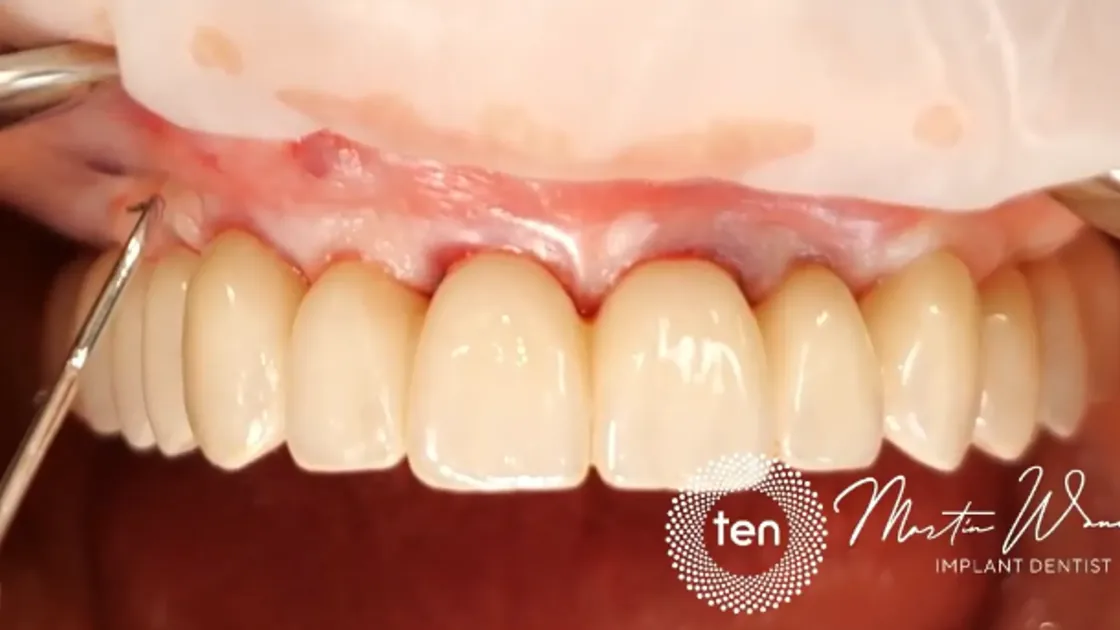 Lesson 4: From the provisional to the final restoration